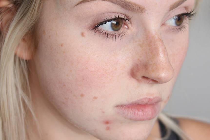 When To See A Skin Doctor For Acne